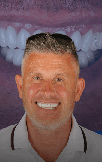 Implante Dentário All on Four