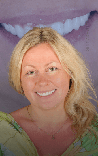 Implantes Dentários