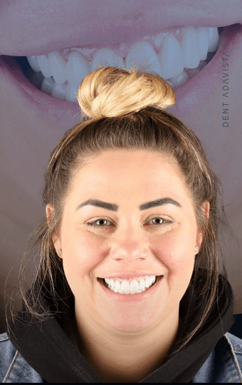 Invisalign