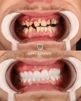 After treatment