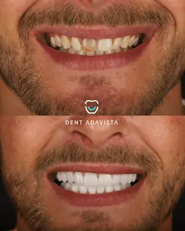 After treatment