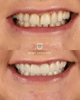 After treatment